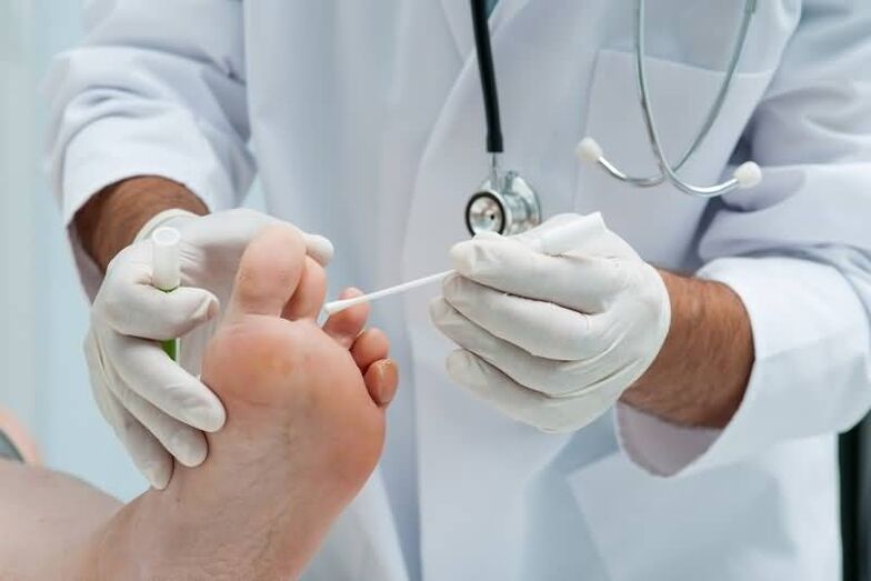 Wenn Sie Symptome eines Zehennagelpilzes haben, sollten Sie einen Dermatologen oder Mykologen aufsuchen. 
