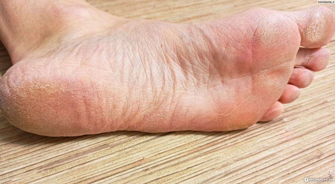 Pilz am menschlichen Fuß